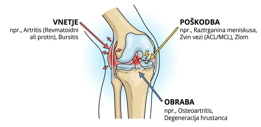 Infografika različnih vzrokov za bolečine v kolenu