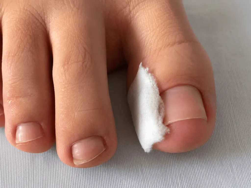 Smrekovit on a cotton pad next to an ingrown toenail