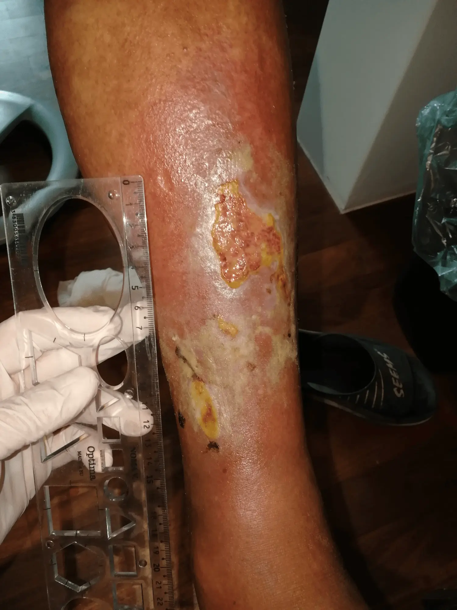 Offene Wunden am Unterschenkel am 9. August 2018 nach fünf Tagen Verlaufskontrolle