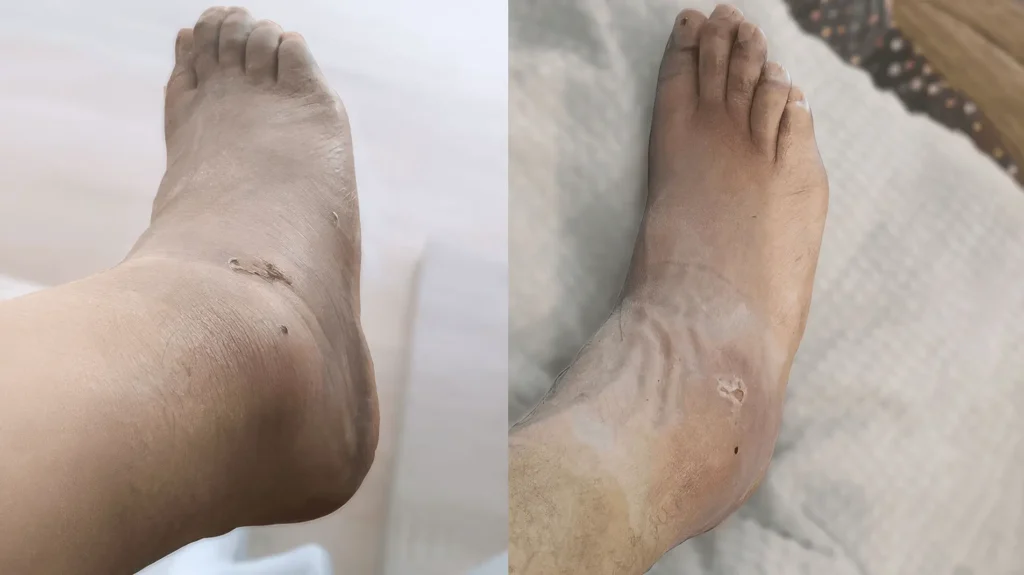 Schwellung des rechten Sprunggelenks nach Luxation und Verlauf der Erholung im November 2018
