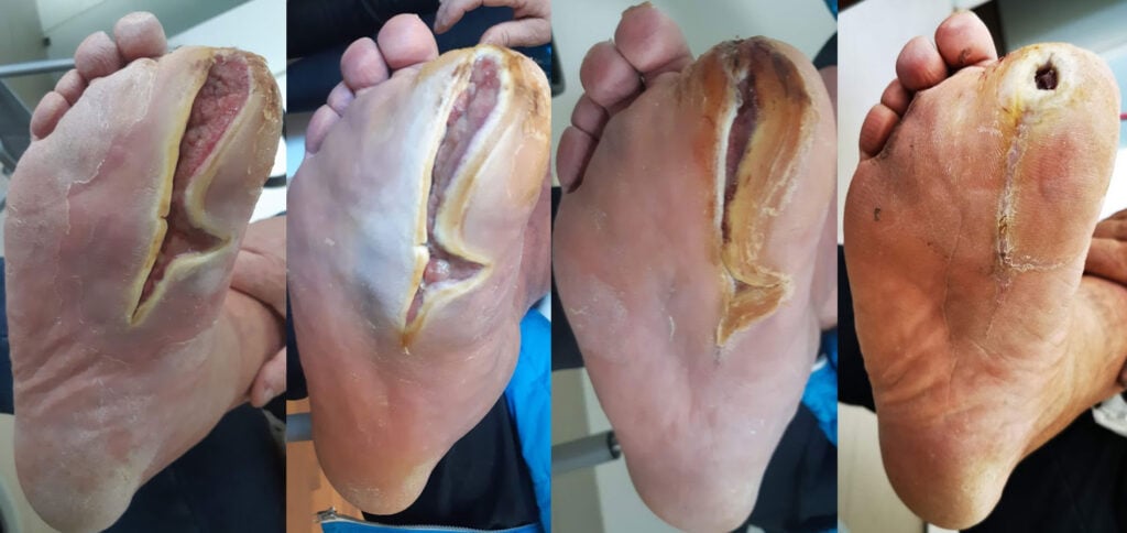 Photographic progression of a chronic diabetic foot wound from 15 January to 18 June 2020